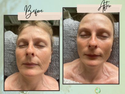 cosmetic acupuncture spear wellbeing clinic windsor